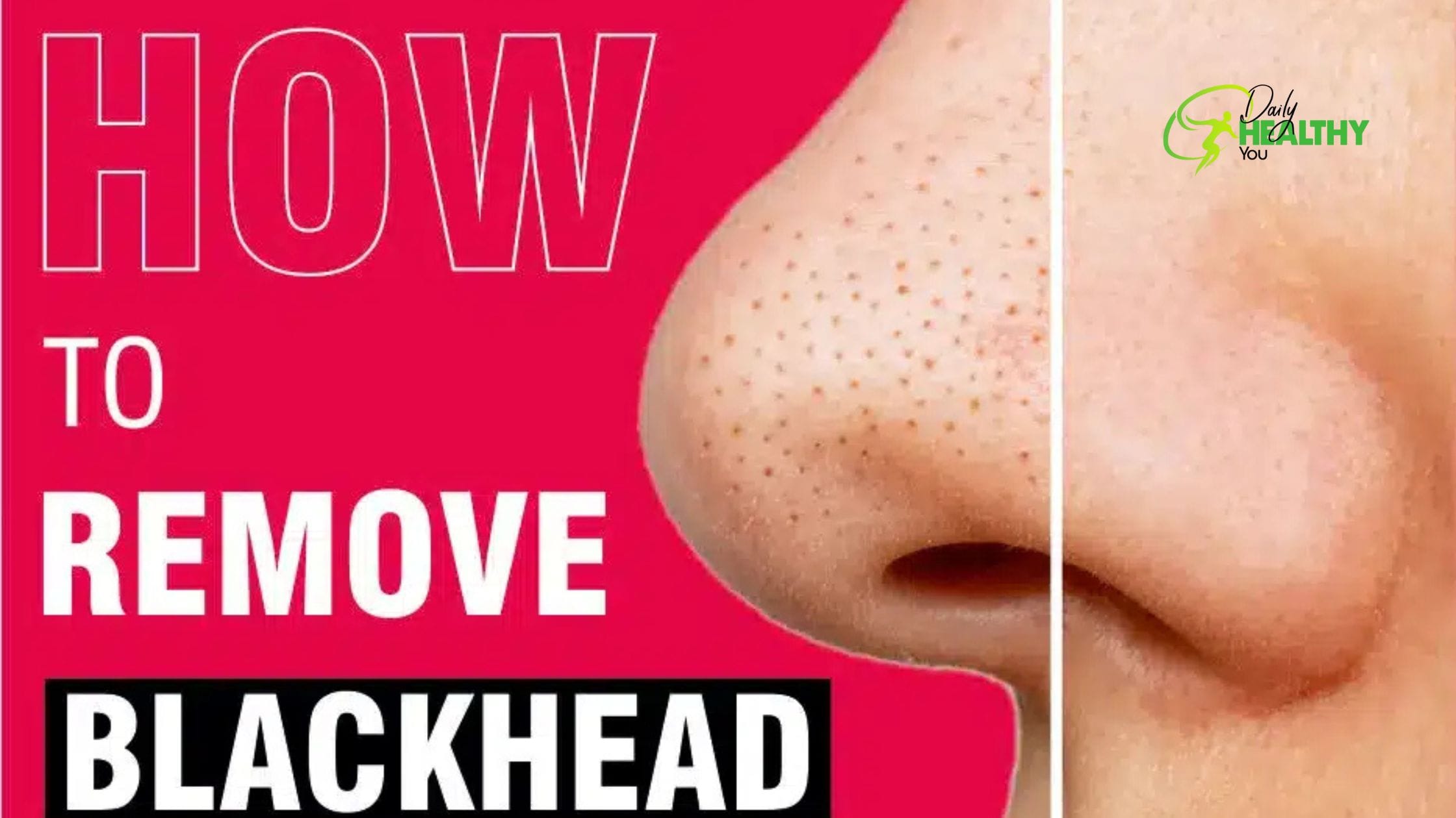 Natural Ways to Get Rid of Blackheads